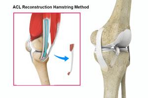 ACL hamsting graft